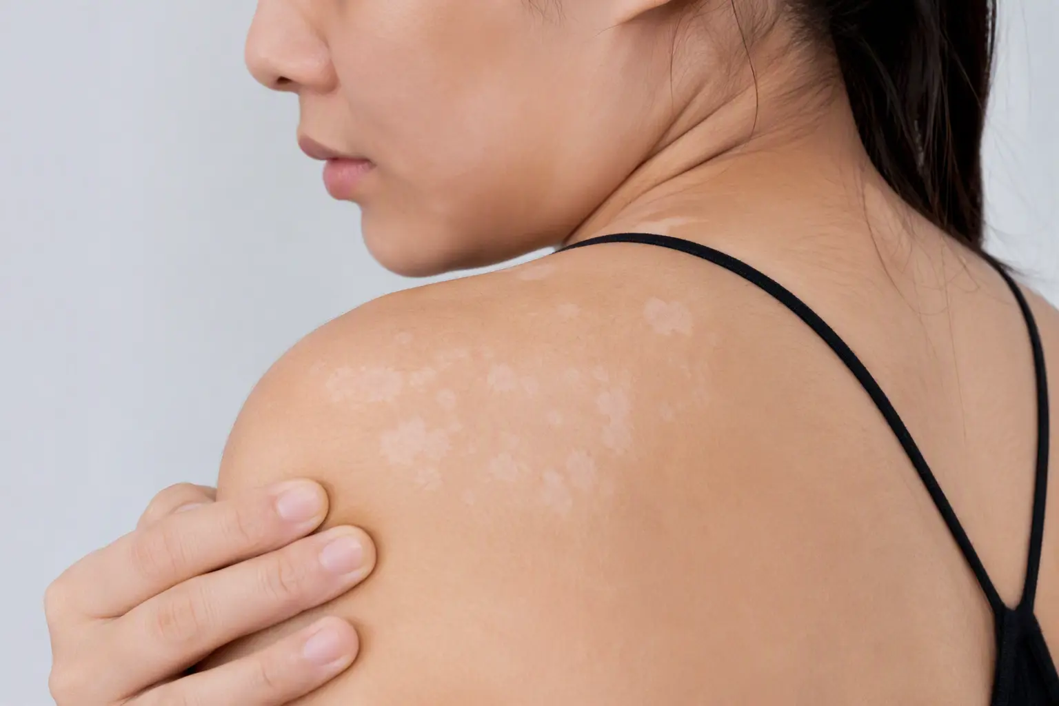 White Spots on Skin: Causes, Symptoms, Treatment and Prevention